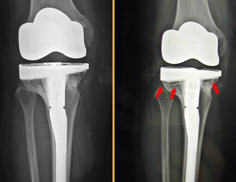 Paziente con dimostrata allergia ad una componente metallica di una protesi al ginocchio, Mobilizzazione radiografica della protesi.jpg 1