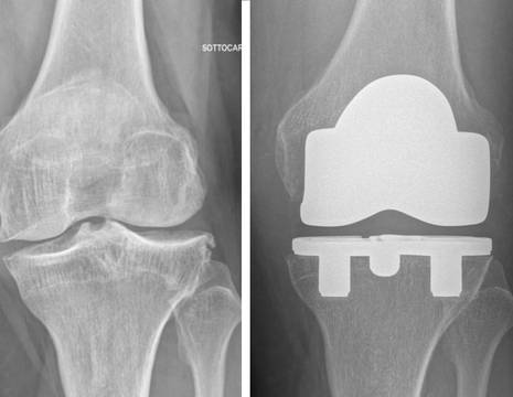 Paziente di 57 anni sciatore sottoposto ad intervento di protesi totale ginocchio NON CEMENTATA 1