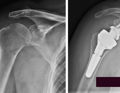 Paziente di 70 anni con spalla pseudoparalitica e sottoposto ad intervento chirurgico di protesi inversa spalla con stelo corto 1