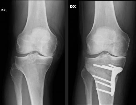 Prima e dopo intervento di osteotomia ginocchio DESTRO 1