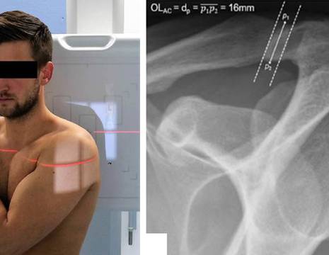 Proeizione secondo Alexander per lussazione acromion-claveare. OL (overlapping line, linea di sovrapposizione) 1