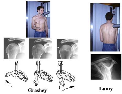 Radiografie di spalla secondo Grashey (cosiddetta AP vera) e secondo Lamy 1
