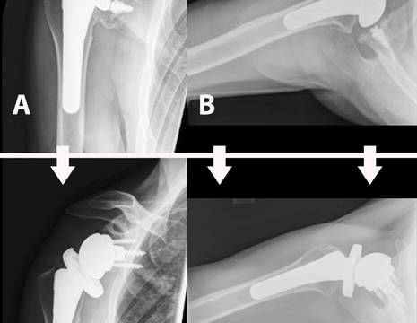 Protesi ANATOMICA di spalla (A e B) trasformata in protesi INVERSA di spalla (C e D) per lesione di sovraspinato e sottoscapolare 3