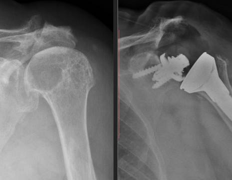 Protesi inversa su artrosi eccentrica di spalla 1