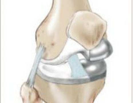 Protesi monocompartimentale al ginocchio 1