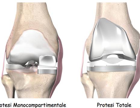 Protesi monocompartimentale e totale del ginocchio 1