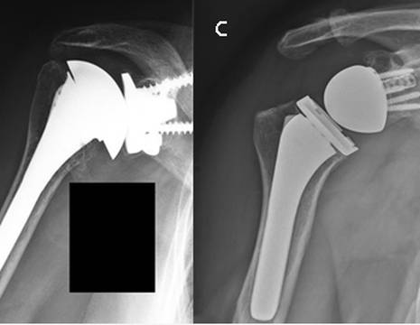 Protesi spalla. A endoprotesi. B protesi anatomica. C protesi inversa. D protesi di rivestimento e stemless 1