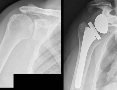 Protesi spalla inversa su recidiva lesione massiva irreparabile cuffia dei rotatori.jpg 1