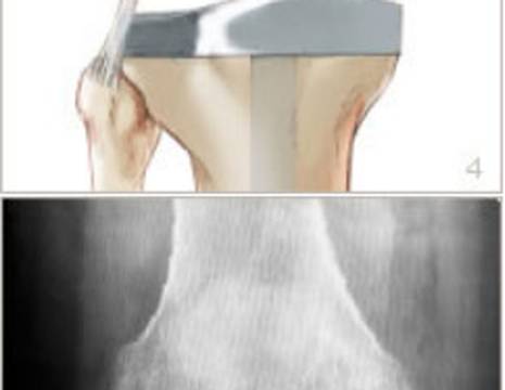 Clicca per ingrandire l'immagine di protesi totale del ginocchio 1