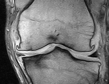 Quadro degenerativo avanzato in paziente con lesione cronica di legamento crociato anteriore.jpg 1
