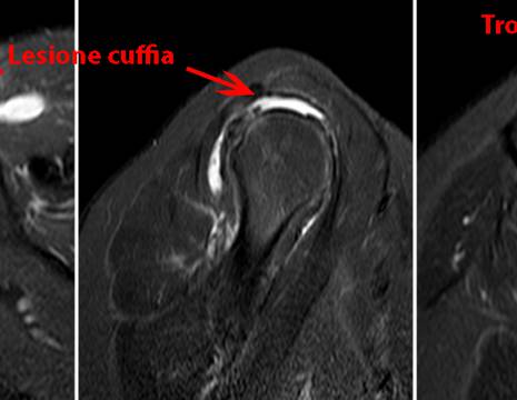 RMN con lesione massiva cuffia rotatori della signora Croce 1