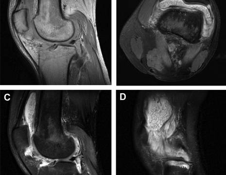 RMN di ginocchio gonfio con patologia infiammatoria dell_articolazione. Notare l_aspetto corpuscolato del versamento.jpg 1