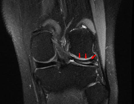 RMN di menisco discoide con fissurazione orizzontale 1
