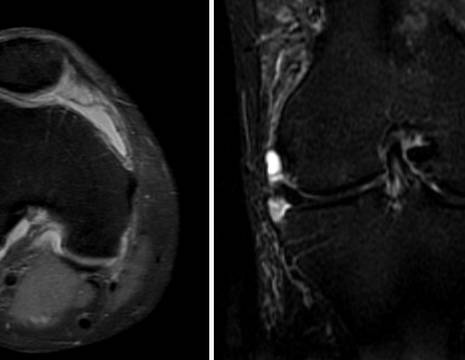 RMN di pz con artrite psoriasica. Versamento ed ispessimento della membrana sinoviale senza segni di interessamento articolare severo 1