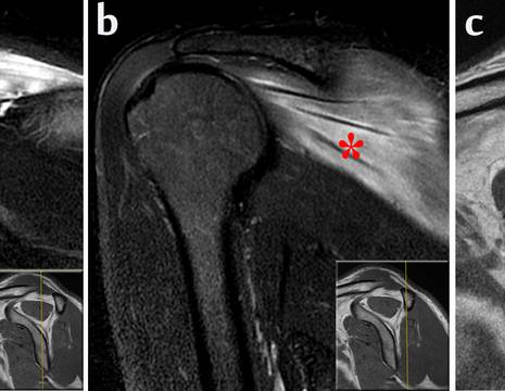RMN di pz con neuropatia del sovrascapolare. A e B edema del muscolo sovra e sottospinoso. C Ipotrofia del muscolo sovraspinoso 1