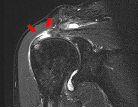 RMN lesione ampia cuffia rotatori spalla.jpg 1