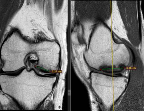 RMN preintervento con osteocondrite di notevoli dimensioni.jpg 1