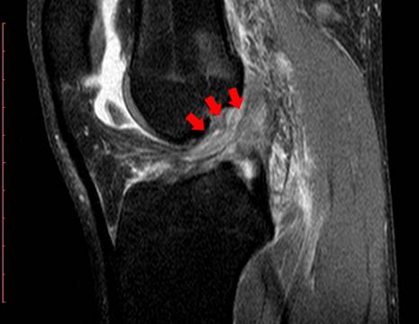 RMN prima dell'intervento, assenza del legamento crociato anteriore (frecce) 2