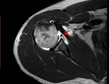RMN prima dell'intervento, la freccia indica la lesione del cercine glenoideo, anche detta lesione Bankart 1