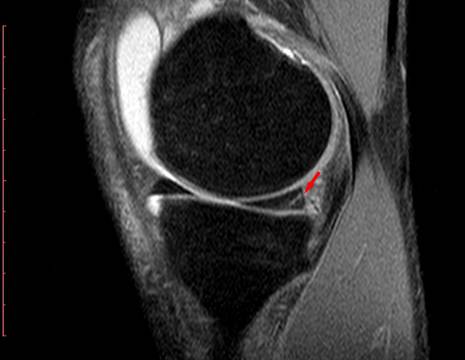 RMN prima dell'intervento, lesione del menisco interno (freccia) 1