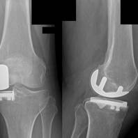 Protesi monocompartimentale di ginocchio