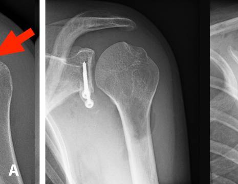 A. Radiografia preoperatoria (freccia rossa lesione Hill-Sachs, freccia nera lesione ossea della glenoide). B. radiografia dopo intervento di Latarjet 1