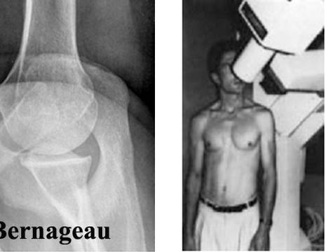 Radiografia di spalla secondo Bernageau (cosiddetto profilo glenoideo) e proiezione apicale obliqua secondo Garth 1