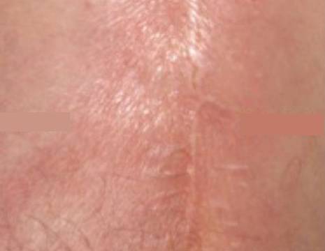 Reazione cutanea di tipo allergico in corrispondenza della cicatrice in un paziente con protesi di ginocchio.jpg 1