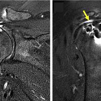 RECIDIVA di lesione della cuffia dei rotatori