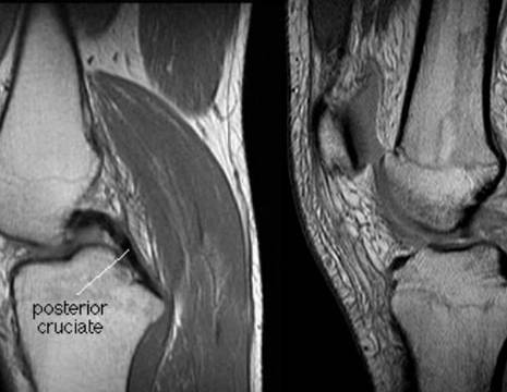 RMN con legamento crociato posteriore intatto e lesionato 1