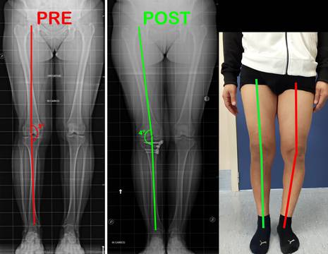 Risultato dopo intervento osteotomia tibiale valgizzante 1