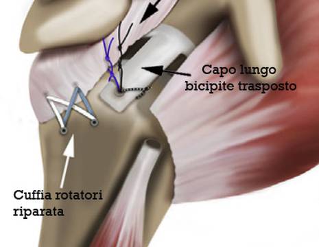 Risultato dopo intervento rinforzo capsula superiore tecnica moderna 1