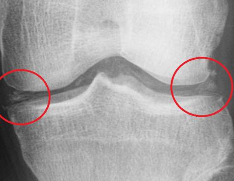 Rx con condrocalcinosi dei menischi, quadro tipico di gotta e pseudogotta 1
