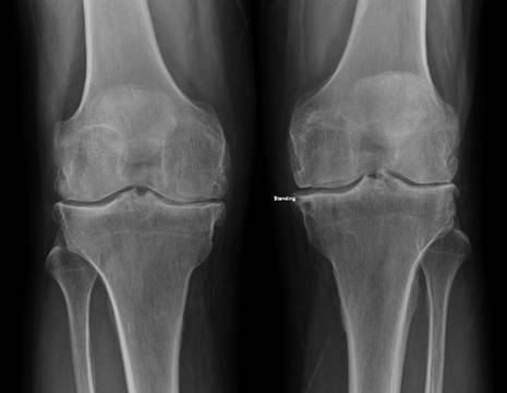 Rx di ginocchio con artrite reumatoide. Erosione ossea oltre segni comuni all'artrosi (osteofiti, restringimento interlinea articolare) 1