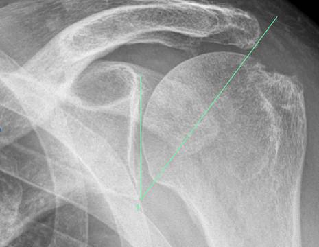 Rx di spalla con misura del CSA _Critical Shoulder Angle_.jpg 1