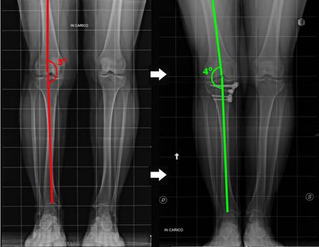 Rx osteotomia ginocchio prima e dopo l'intervento 1