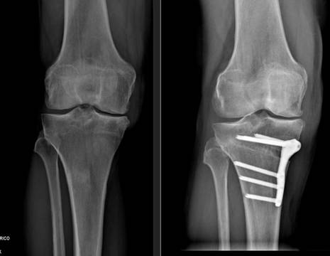 Rx prima e dopo intervento di osteotomia tibiale valgizzante al Sig. Giancarlo.jpg 1