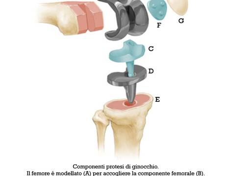 Schema componenti protesi di ginocchio 1