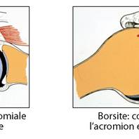 Sindrome da conflitto subacromiale