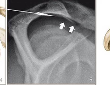 Schema intervento acromioplastica di spalla in artroscopia 1