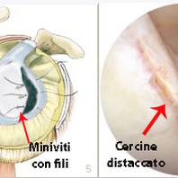 Intervento di artroscopia alla spalla per lussazione (o riparazione lesione Bankart)