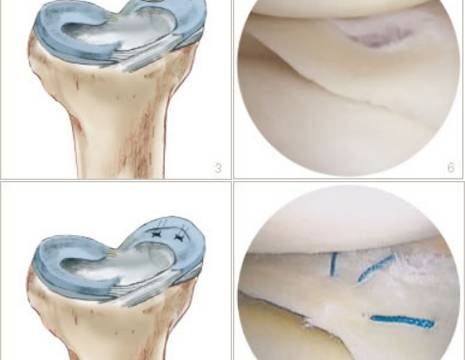 Schema intervento di sutura lesione menisco in artroscopia 1