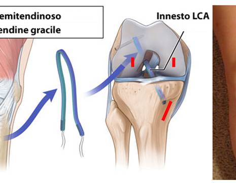 Schema intervento ricostruzione LCA con ischio_crurali e cicatrici chirurgiche 2