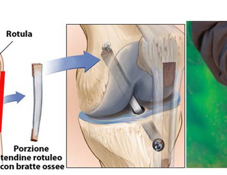 Schema intervento ricostruzione LCA con tendine rotuleo 1
