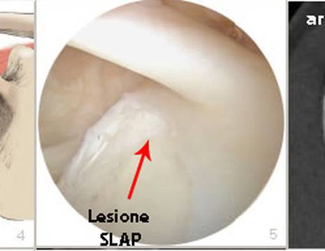 Schema intervento riparazione lesione SLAP in artroscopia 1