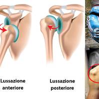 Lussazione ed Instabilità della spalla