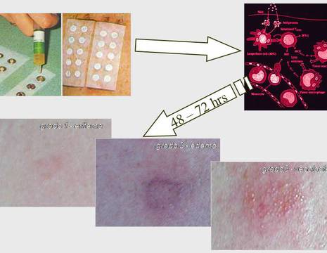 Schema patch test per sospetta allergia a protesi di ginocchio.jpg 1