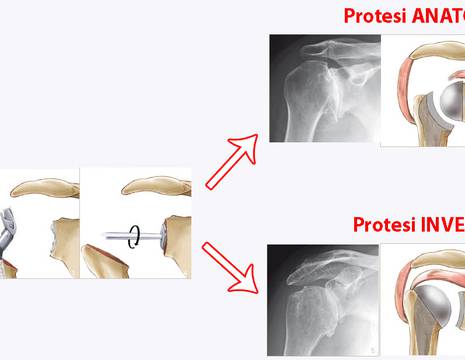 Schema protesi anatomica, inversa spalla 1