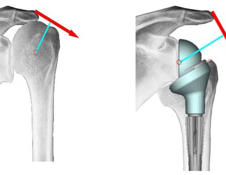 Schema protesi inversa. Il centro di rotazione (pallino rosso) medializzato ed abbassato migliora il braccio di leva del deltoide (freccia rossa) 1
