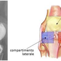 Dolore anteriore di ginocchio e sindrome da iperpressione della rotula